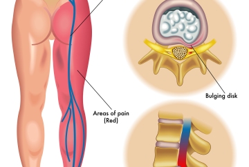 medical illustration of symptoms of the sciatica down the leg