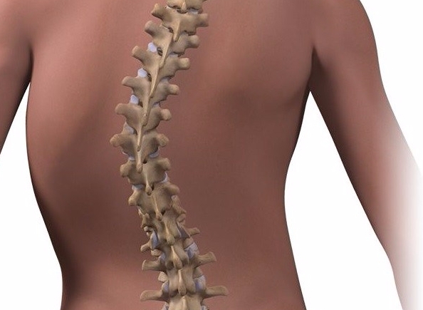 Illustration of an S shaped scoliosis curve of the spine